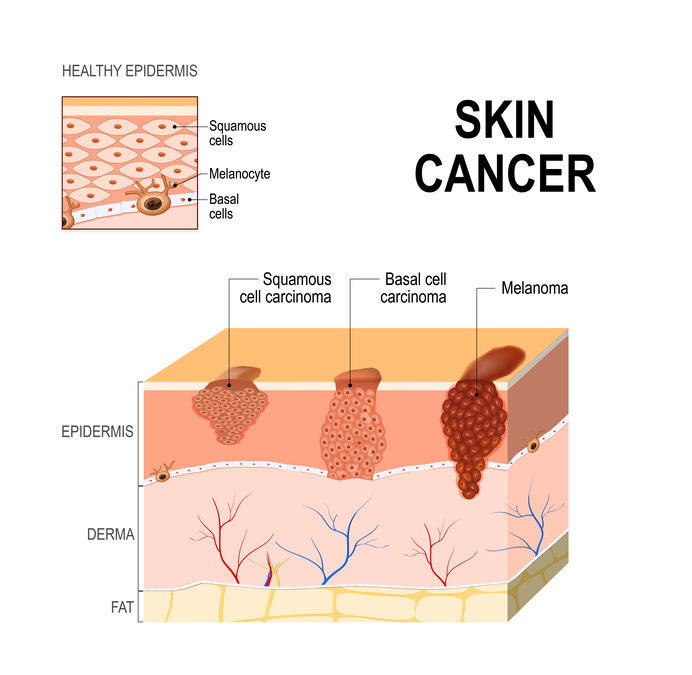 skin cancer types